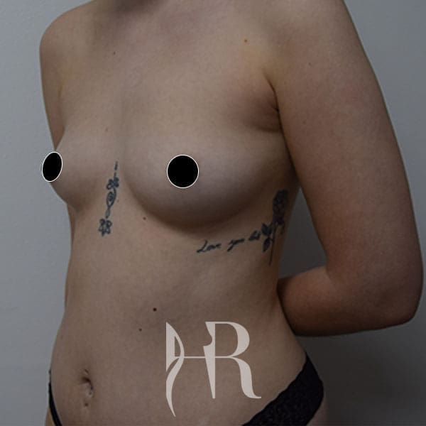HR Plastic Surgery - Breast Enlargement patient before 7